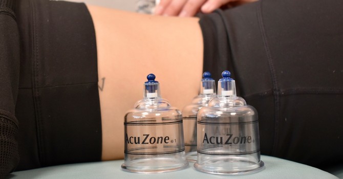 Cupping Therapy (Fire & Suction)